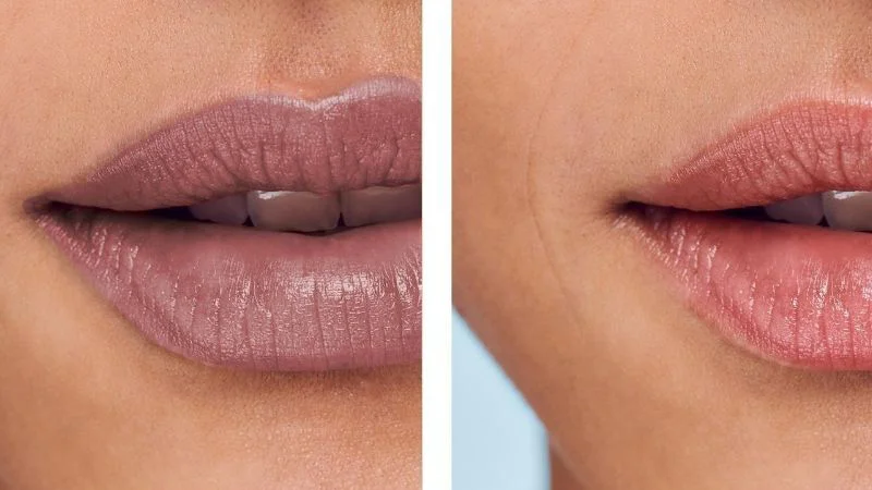 Giới Thiệu về Dịch vụ khử thâm môi Nam / Nữ