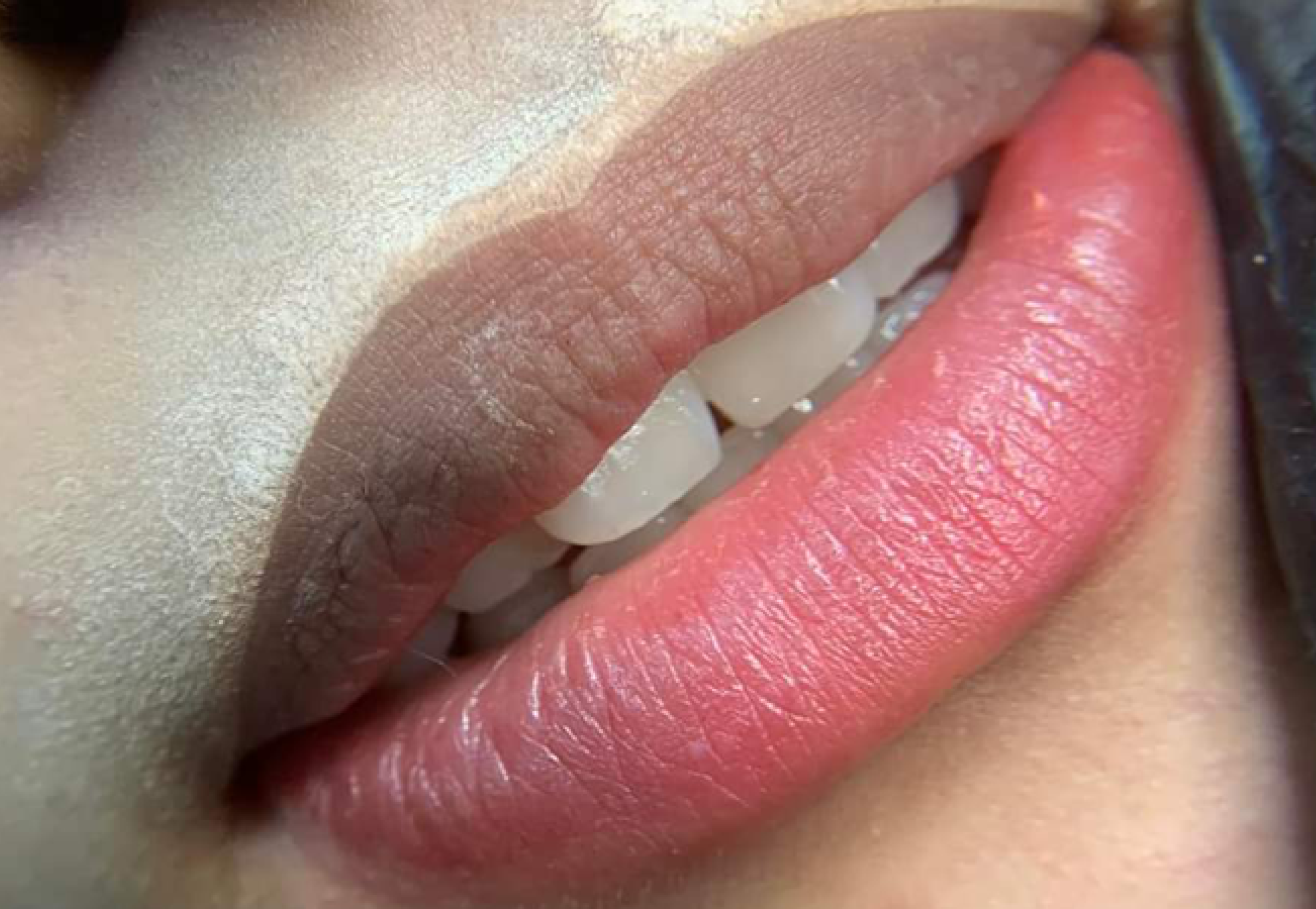 Thoát khỏi nỗi ám ảnh môi thâm, rạng rỡ đón nắng với phun xăm khử thâm môi