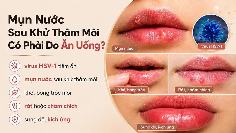 Vì sao khử thâm môi xong vẫn bị nổi mụn nước dù ăn uống rất kỹ? Vì sao khử thâm môi xong vẫn bị nổi mụn nước dù ăn uống rất kỹ?