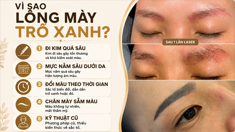 Những lý do khiến lông mày của bạn trổ xanh đỏ Những lý do khiến lông mày của bạn trổ xanh đỏ